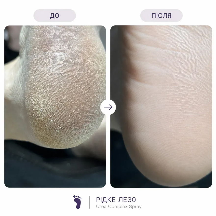 Grade Рідке лезо Urea Complex Spray, 150 мл