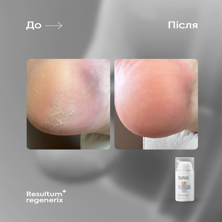 Resultum крем від тріщин для рук і стоп Regenerix, 50 мл Resultum крем від тріщин для рук і стоп Regenerix, 50 мл