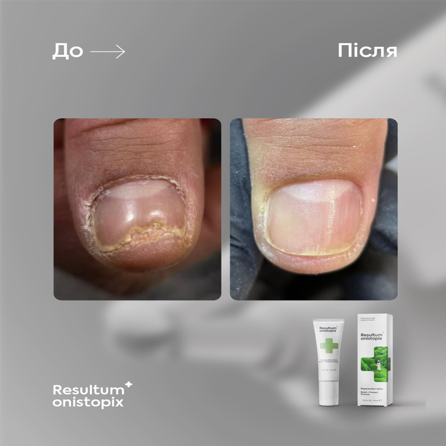 Resultum регенеруючий лосьйон від оніхолізису та грибка Onistopix, 10 мл