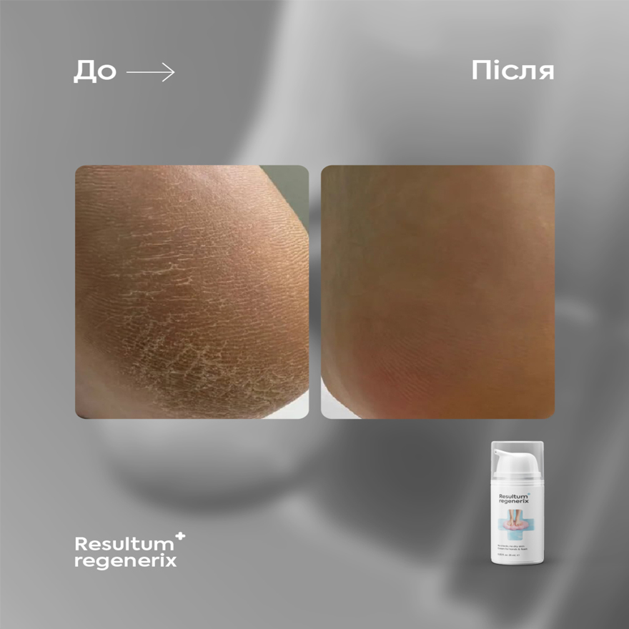 Resultum крем від тріщин для рук і стоп Regenerix, 50 мл Resultum крем від тріщин для рук і стоп Regenerix, 50 мл