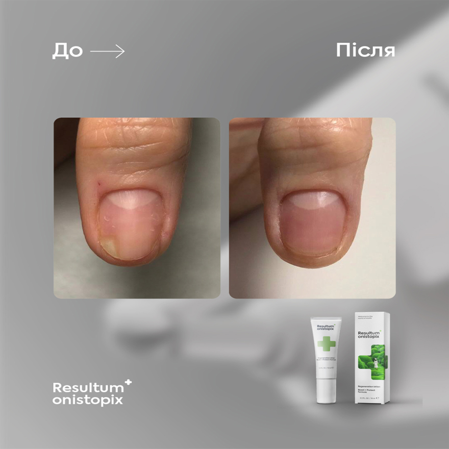 Resultum регенеруючий лосьйон від оніхолізису та грибка Onistopix, 10 мл