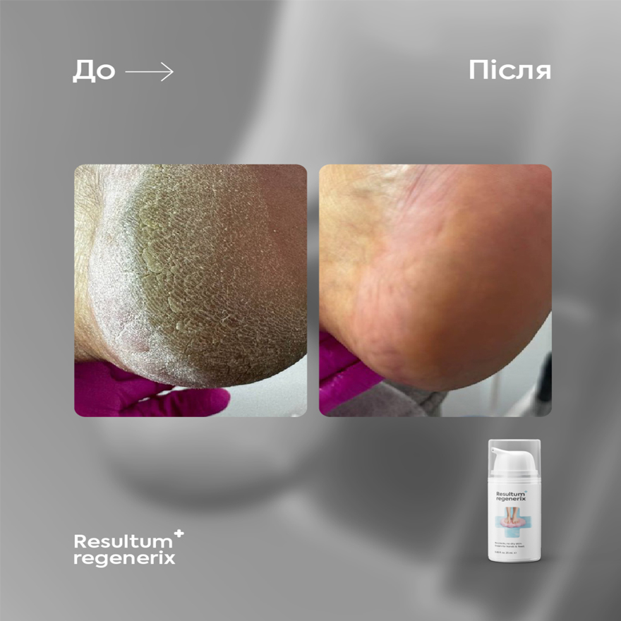Resultum крем від тріщин для рук і стоп Regenerix, 50 мл Resultum крем від тріщин для рук і стоп Regenerix, 50 мл