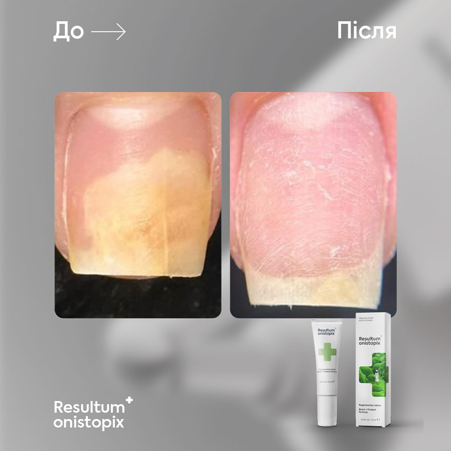 Resultum Олія від оніхолізису Onistopix Oil, 15 мл