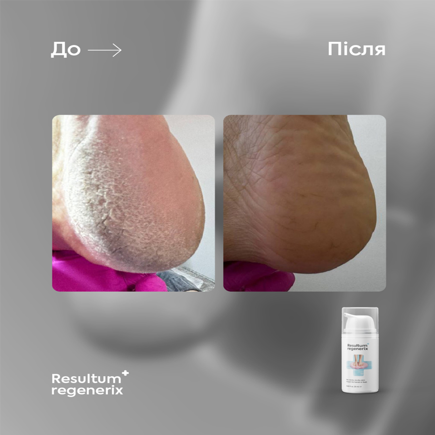 Resultum крем від тріщин для рук і стоп Regenerix, 50 мл Resultum крем від тріщин для рук і стоп Regenerix, 50 мл