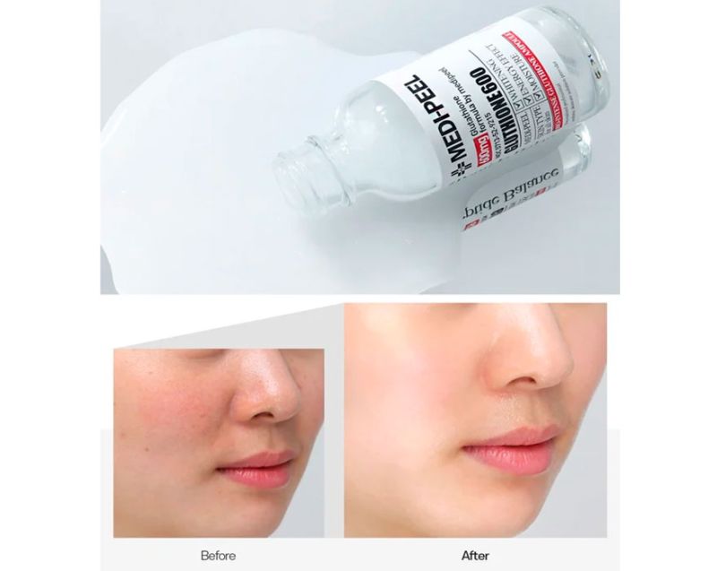 glutathione good for psoriasis Luthione Cindella Ascorbic Acid Vitamin C Skin Whitening Injection Gluthion  Inj Gluthaone Chioctocin Inj Glutathione 600mg 1200mg Injection - Gluthion  Inj Glutax Glutathione Injections, Glutathione Alpha Lipoic Acid Vitamin C main image 0