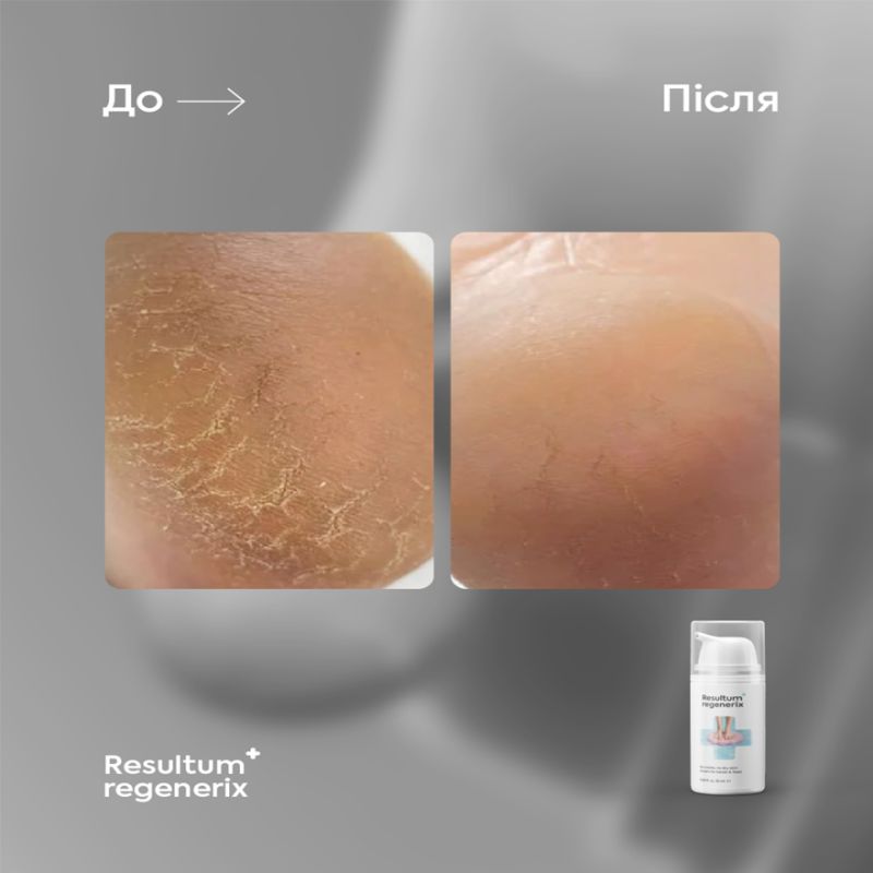 Resultum крем від тріщин для рук і стоп Regenerix, 50 мл