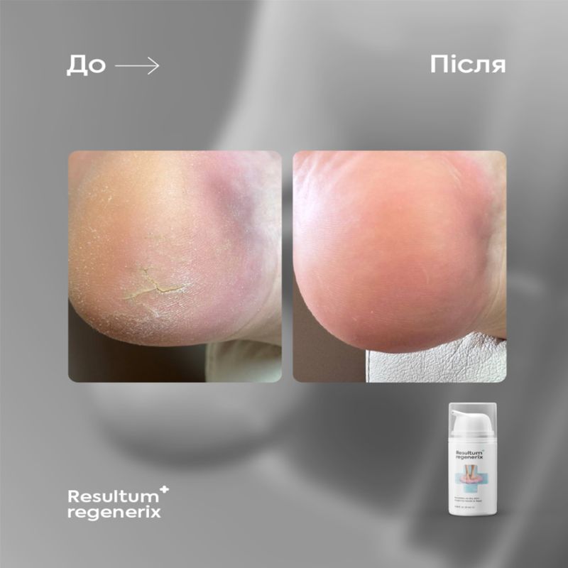 Resultum крем від тріщин для рук і стоп Regenerix, 50 мл