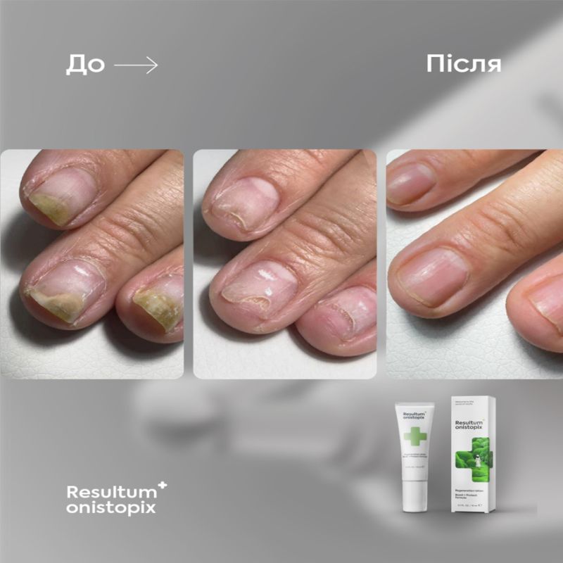 Resultum регенеруючий лосьйон від оніхолізису та грибка Onistopix, 10 мл
