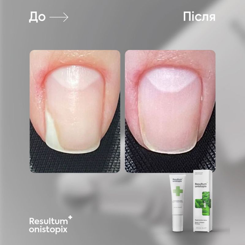 Resultum Олія від оніхолізису Onistopix Oil, 15 мл