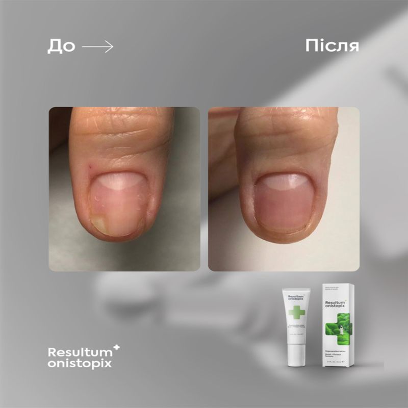 Resultum регенеруючий лосьйон від оніхолізису та грибка Onistopix, 10 мл