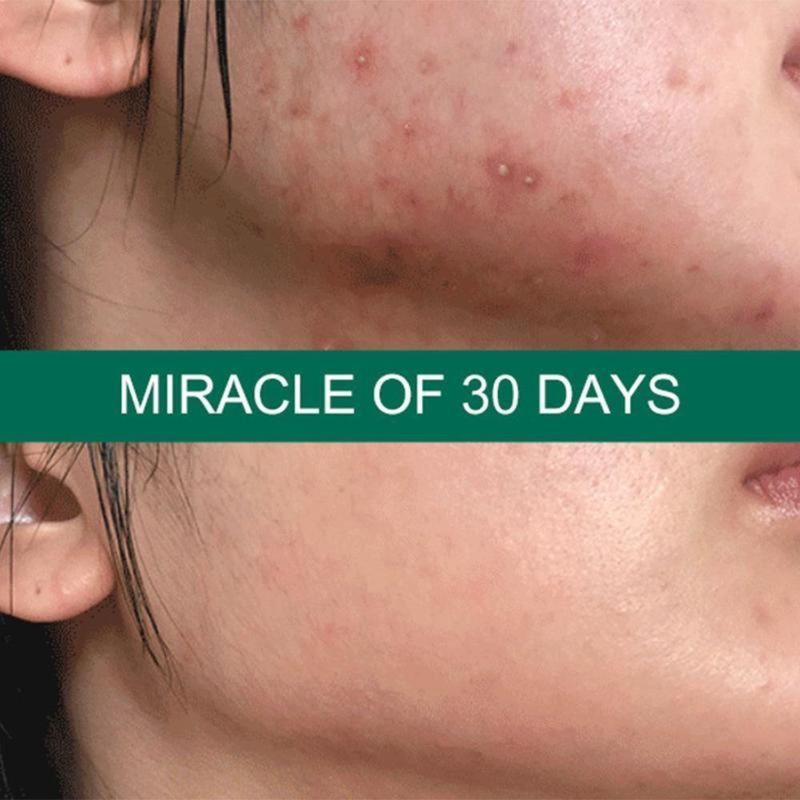 Some By Mi AHA-BHA-PHA 30 Days Miracle Serum - Serum for problem skin, 50 ml